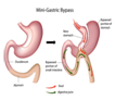 One Anastamosis Gasric Bypass OAGB